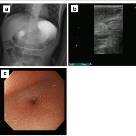 Laparoscopic Heinekemikulicz Pyloroplasty Dog No 3 Ventrodorsal