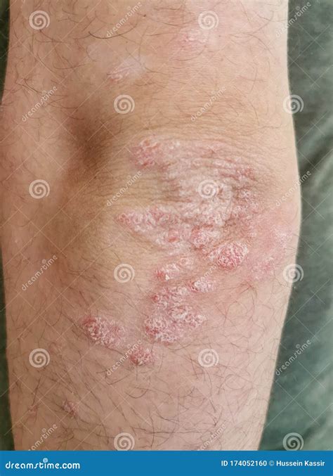 Elbow Skin Psoriasis Disease Problem Stock Photo Image Of Elbows