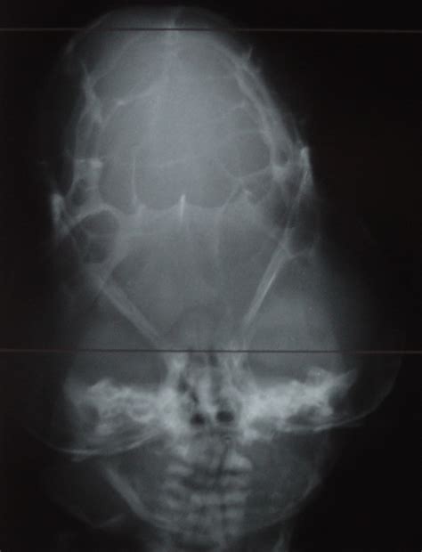 Cloverleaf Skull Syndrome Neurorad911