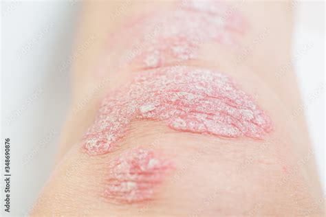 Acute Psoriasis On The Knees Is An Autoimmune Incurable Dermatological
