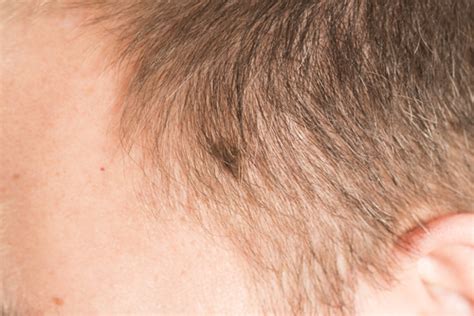 Head And Neck Melanomas Often Most Advanced Where Hardest To See