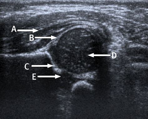 Coronal Ultrasound Anatomy Of A Normal Hip In A Newborn Baby The Bmj