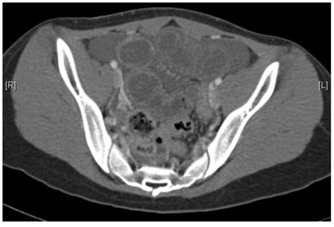 Computed Tomography Scan Showing Dilated Small Bowel Loops And Mucosal