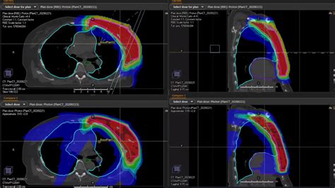 Advances In Radiation Oncology Proton Therapy For Breast Cancer Broadcastmed