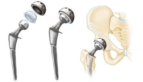 Revision Hip Replacement Neemtree Healthcare
