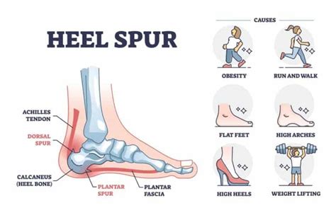Heel Spur Treatment By A Physical Therapist Including Exercises