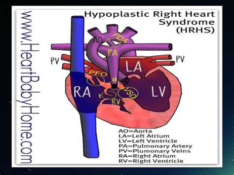 Hypoplastic Right Heart Syndrome Captions Save