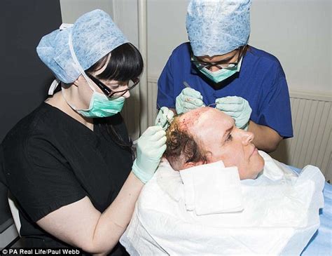 Transgender Woman Receives Hair Transplant From A Robot Daily Mail Online