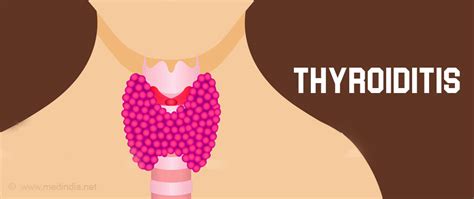 Thyroiditis Types Causes Symptoms Diagnosis Treatment