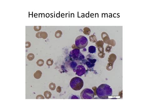Hemosiderin Laden Macrophages Iachareoy