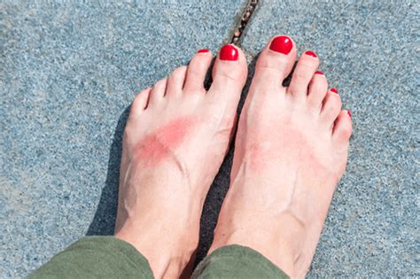 Types Of Rashes On Feet