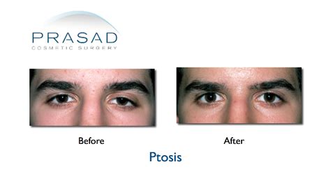 ptosis correction surgery eyelifts by dr amiya prasad md facs