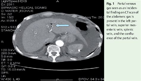 Figure 1 From Hepatic Portal Venous Gas Pvg Is A Rare And Often