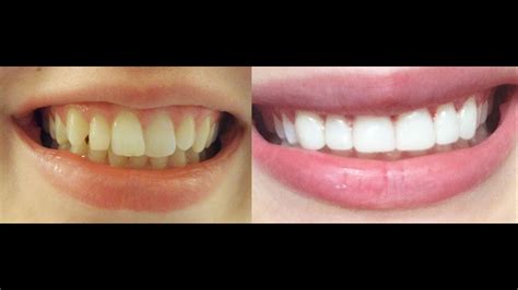 How To Get Instant Straight Teeth Without Braces Veneers And Whitening