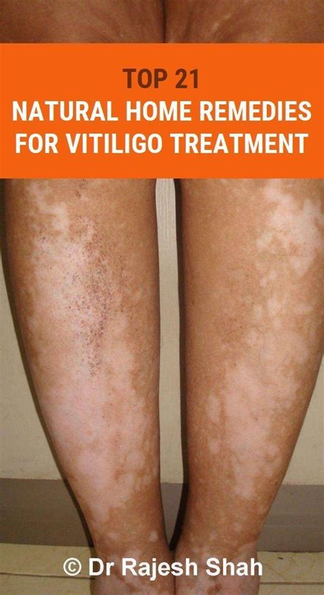 Pin On Vitiligo