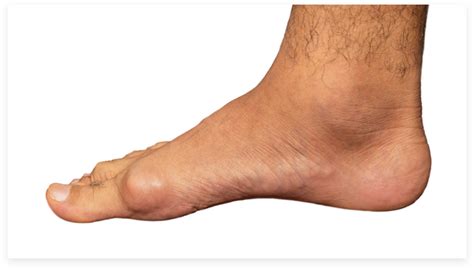 Gout Tophi Treating Or Living With Tophi