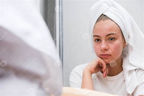 Acne A Sad Teenage Girl Problematic Skin In Adolescents Stock Image