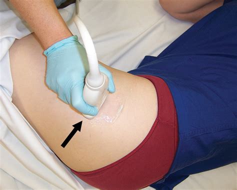 Ultrasound Guided Corticosteroid Injections For Treatment Of Greater