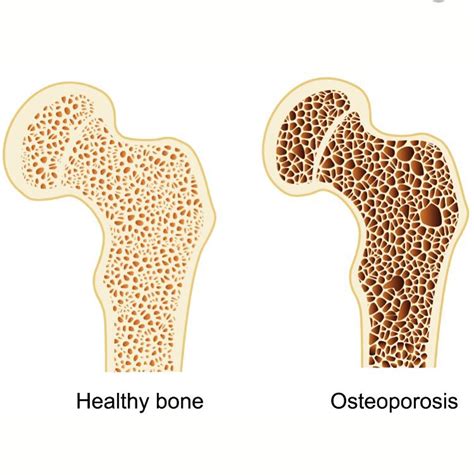 Bone Density Can Be Increased By Sciencehub