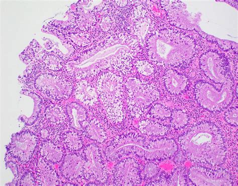 Pathology Outlines Tubular Adenoma