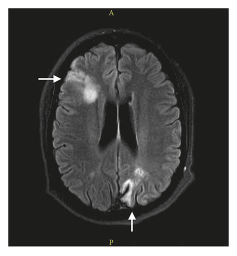 Contrast Mri Brain T2 Flair Showing Right Frontal Subacute And Left