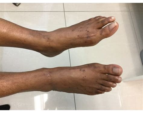 Derm Dx Scaly Bumps On Feet And Ankles Clinical Advisor