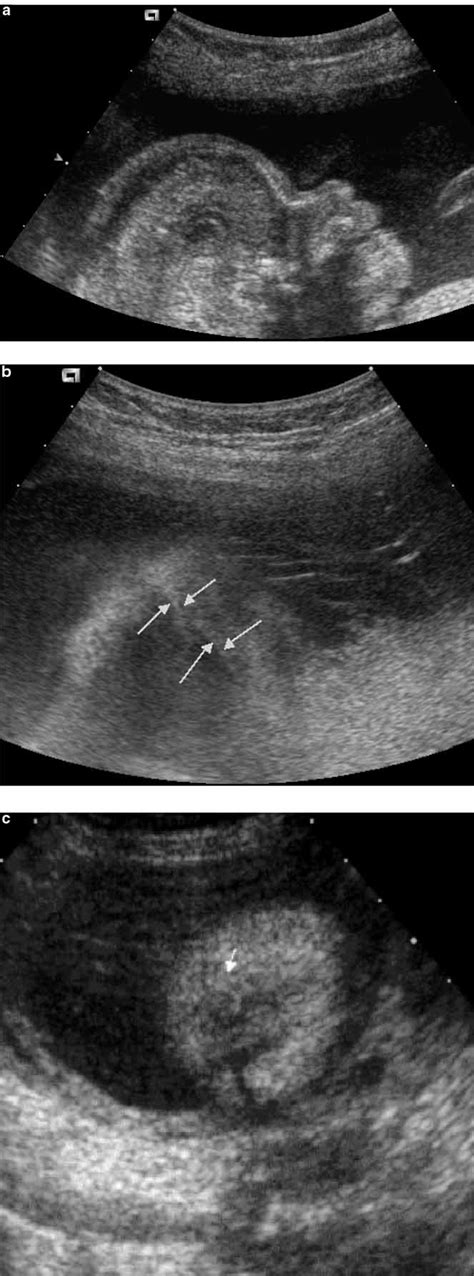 Prenatal Ultrasound Diagnosis Of Fetal Craniosynostosis Delahaye