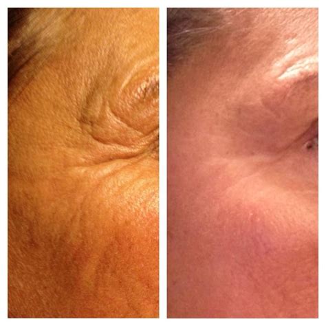 My Moms Nerium Results Day 1 And Day 12 Nerium Ad Nerium Results