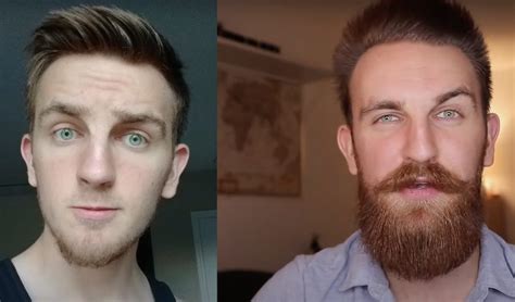 Minoxidil For Beard Growth Works Studies Before And After Photos