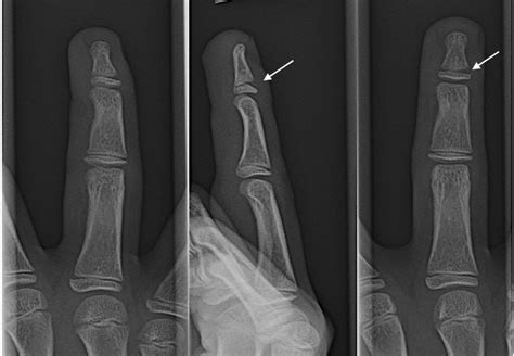Finger Distal Phalanx Fracture Pediatric Hand Surgery Resource