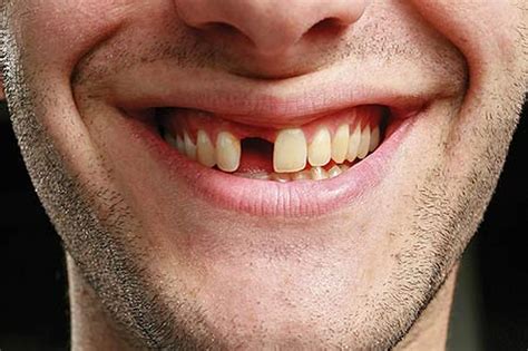 Missing Teeth Prestige Oral Surgery