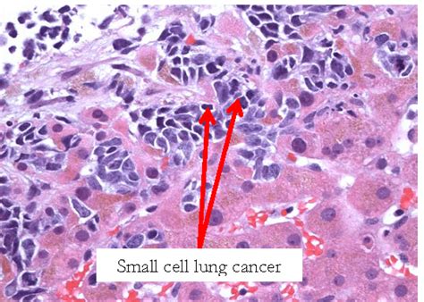 Treatment Of Small Cell Lung Cancer 4th Edition Lung Cancer