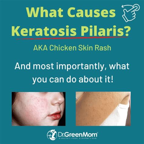 Treatment For Keratosis Pilaris Dr Green Mom