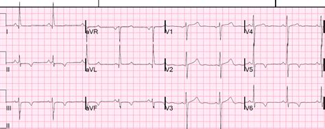 Dr Smiths Ecg Blog St Changes Due To Limb Lead Lvh
