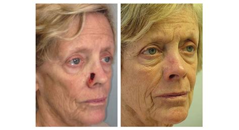 Facial Reconstruction Before And After Gallery Mount Sinai New York
