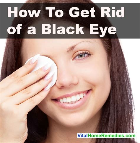 How To Get Rid Of A Black Eye Vital Home Remedies Black Eye