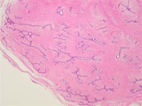 Fibroadenoma A Common Benign Breast Tumor