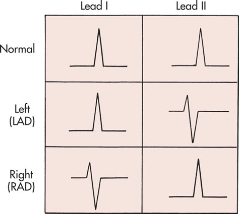Electrical Axis and Axis Deviation - BASIC PRINCIPLES AND PATTERNS