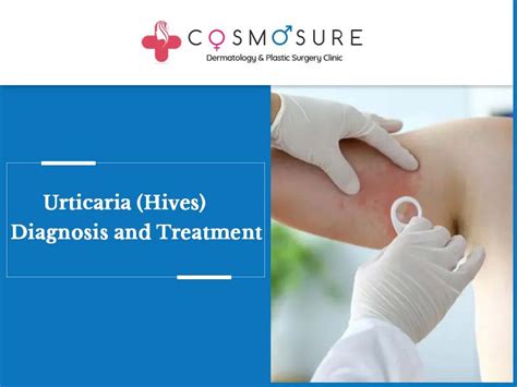 Urticaria Hives Diagnosis And Treatment Cosmosure Clinic
