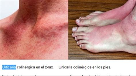 Qué Es La Urticaria Colinérgica Síntomas Y Tratamiento Youtube