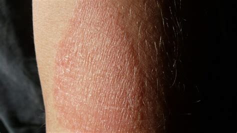 What Causes Eczema Symptoms Causes And Treatment Waxelene