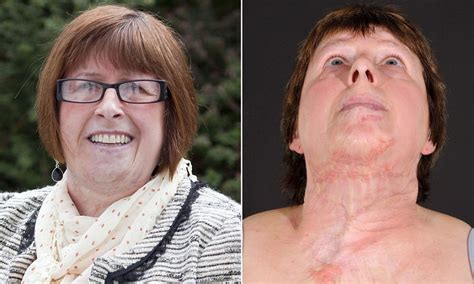 woman who suffered horrific burns in freak accident is the first in the world to have her