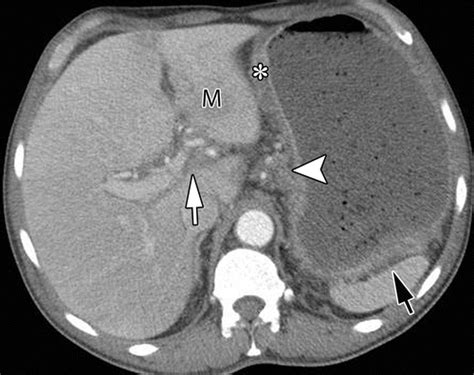 Ligaments And Lymphatic Pathways In Gastric Adenocarcinoma Radiographics