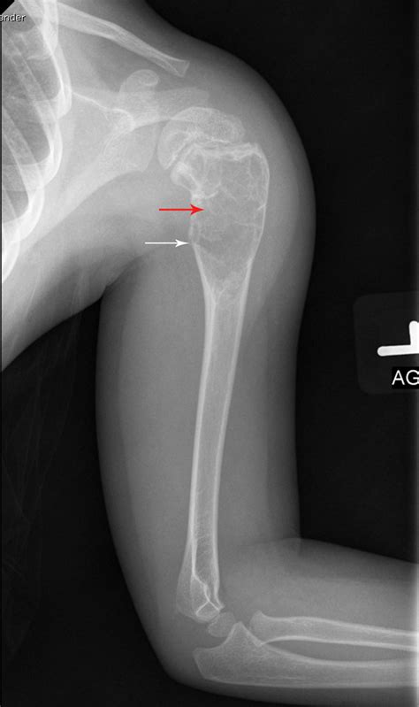 What Is This Bone Cyst Radiology Key