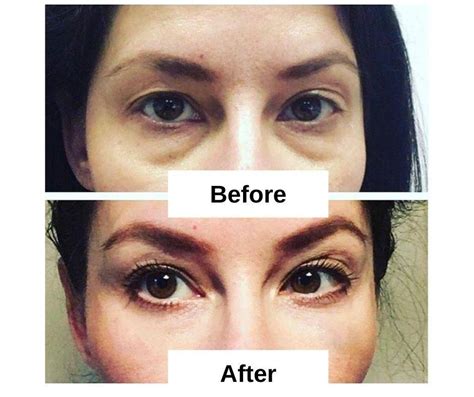 Sunken Eyes Guide Pics Causes 15 Proven Home Remedies 2023 Fabbon