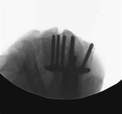 Radiographic Parameters Of Distal Radius Fractures Musculoskeletal Key