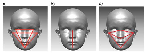 Jcm Free Full Text Craniofacial Asymmetry From One To Three Years