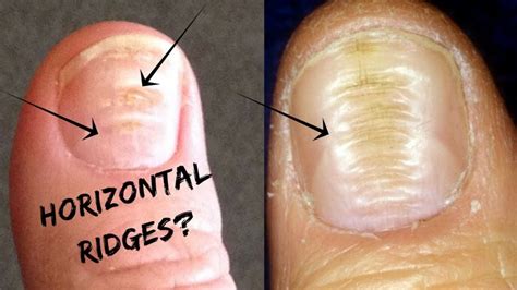If the nail stops growing, a visit to the dermatologist is more than recommended. Do You Have These Horizontal Ridges(Lines) On Your Nails ...