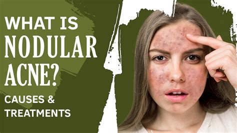 Know Everything About Nodular Acne Causes And Treatments Acne Wiki
