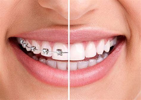 Why Choose Dental Implants At Uppal Dental Dr Uppal Site